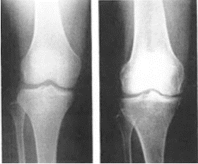 変形性膝関節・変形性股関節の幹細胞再生手術（治療）後のリハビリは重要