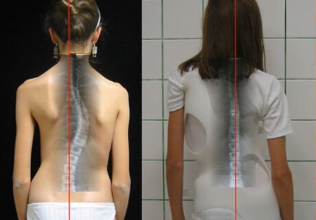 We recommend The Cheneau-Gensingen Brace for the scoliosis !!         it is effective  !!