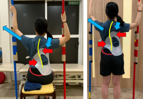 特発性側弯症に対するシェノー装具治療の効果について（Wanke L. 他, JOR Spine, Vol.14, No.2, 2022）