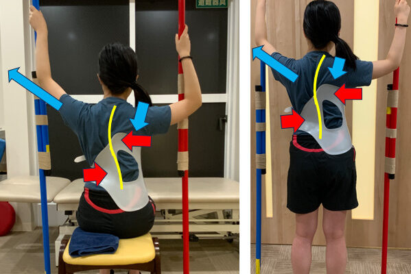 特発性側弯症に対するシェノー装具治療の効果について（Wanke L. 他, JOR Spine, Vol.14, No.2, 2022）