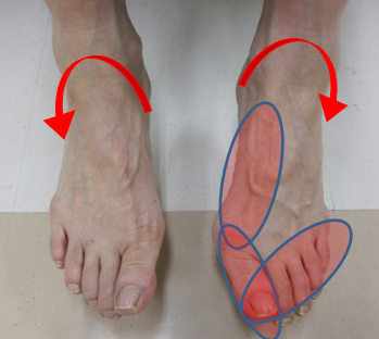 How About Foot Therapy and Custom Insoles by Specialized Podiatric Physiotherapists for Foreign Residents in Japan and Tourists Visiting Japan?　（ English-speaking physiotherapists are available to assist you !! )