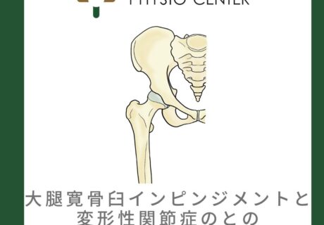 大腿骨寛骨臼インピンジメントと形性股関節症との関係について