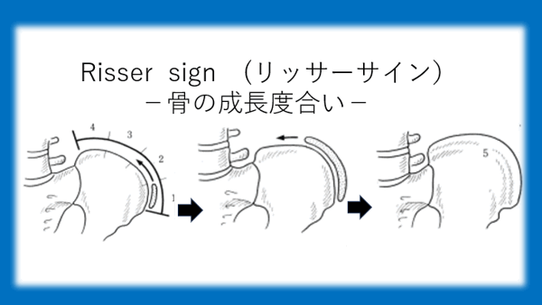Risser sign（リッサーサイン）と側弯治療の関係とは？　非常に重要な骨の成長度合いです。