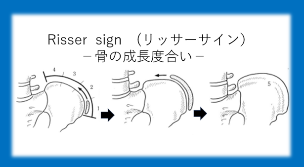 Risser sign（リッサーサイン）と側弯治療の関係とは？　非常に重要な骨の成長度合いです。