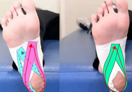 Relief for Plantar Fasciitis While Traveling in Japan – Immediate Taping Support for Tourists ( for foreign tourists)