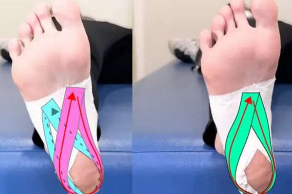 Relief for Plantar Fasciitis While Traveling in Japan – Immediate Taping Support for Tourists ( for foreign tourists)