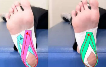 Relief for Plantar Fasciitis While Traveling in Japan – Immediate Taping Support for Tourists ( for foreign tourists)