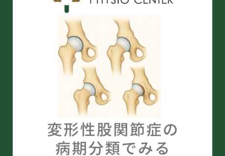 変形性股関節症の病期分類でみる症状変化と運動戦略