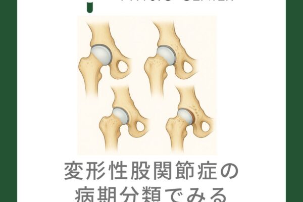 変形性股関節症の病期分類でみる症状変化と運動戦略