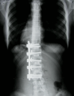 For those suffering from shoulder stiffness, lower back pain, or discomfort after scoliosis fusion surgery: Try safe conditioning therapy focused on breathing.　for foreign residents in Japan.