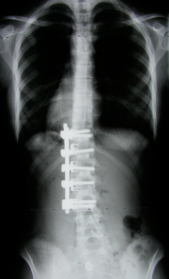For those suffering from shoulder stiffness, lower back pain, or discomfort after scoliosis fusion surgery: Try safe conditioning therapy focused on breathing.　for foreign residents in Japan.