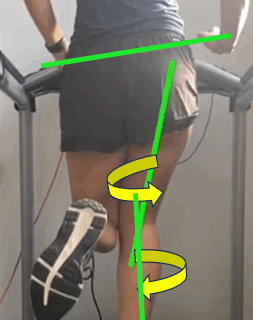 The Role of Custom Insoles in Managing Knee Valgus  For Foreign Residents in Japan Tokyo