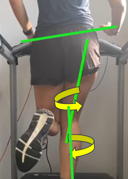 The Role of Custom Insoles in Managing Knee Valgus  For Foreign Residents in Japan Tokyo