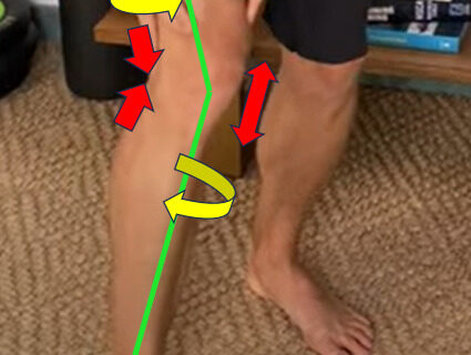 Support for Foreign Residents in Japan Suffering from Knee Valgus (Knock Knees) – Physiotherapy at Physio Center