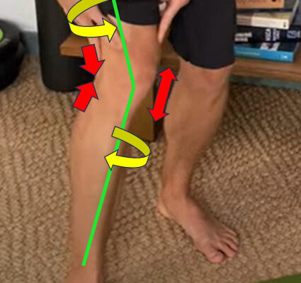 Support for Foreign Residents in Japan Suffering from Knee Valgus (Knock Knees) – Physiotherapy at Physio Center