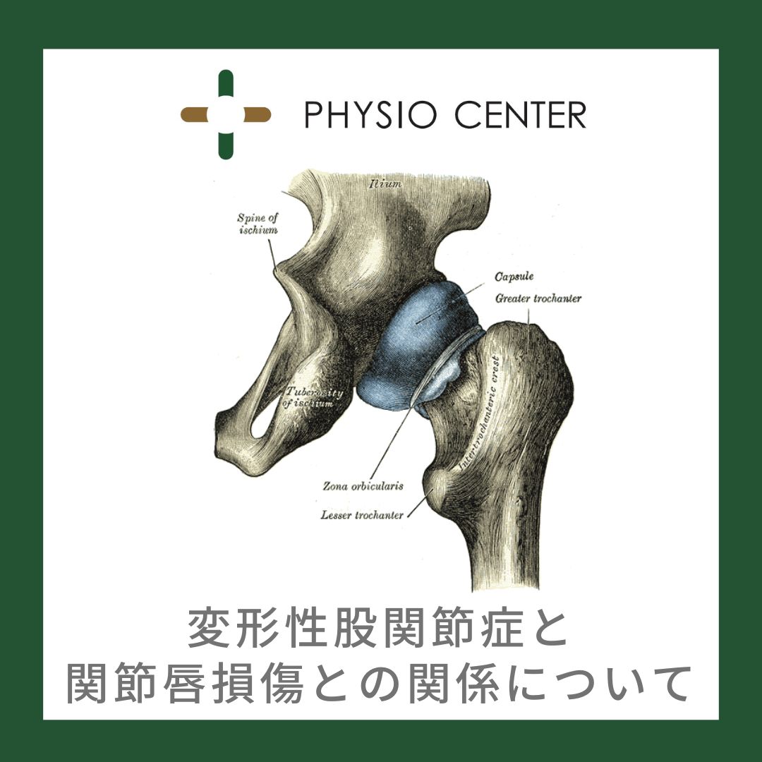 変形性股関節症と関節唇損傷との関係について