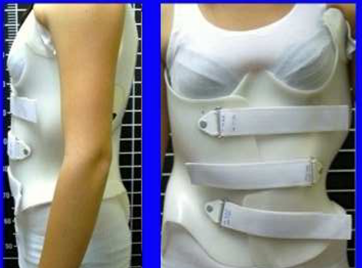 The Evolution of Bracing Therapy: A New Three-Dimensional Approach with the Chêneau Brace　for