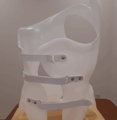 【側弯症治療に対する研究報告のご紹介】思春期特発性側弯症に対するシェノー装具の効果