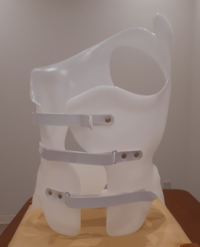 【側弯症治療に対する研究報告のご紹介】思春期特発性側弯症に対するシェノー装具の効果