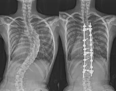 側弯症の手術後のリハビリについて解説します。