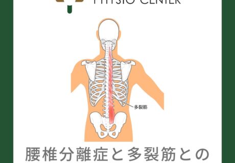 腰椎分離症と多裂筋との関係について