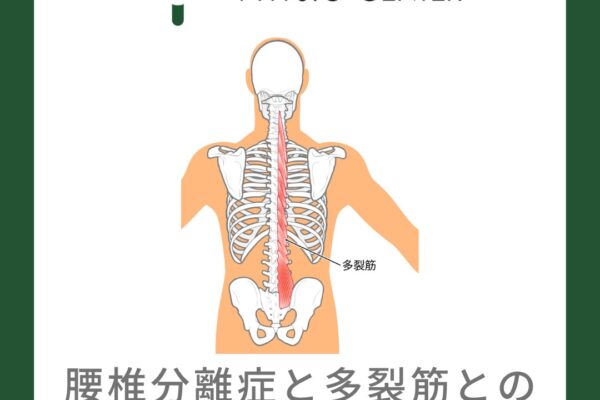 腰椎分離症と多裂筋との関係について