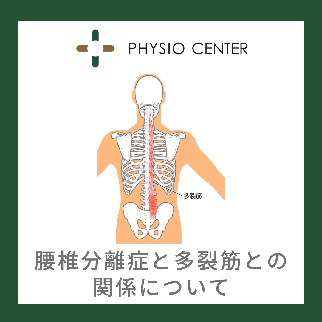 腰椎分離症と多裂筋との関係について