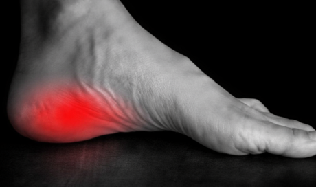 Plantar Fasciitis Treatment Guide | From Conservative Care to Minimally Invasive Therapies