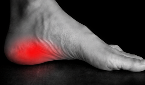 Plantar Fasciitis Treatment Guide | From Conservative Care to Minimally Invasive Therapies