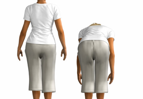 成長期以降の側弯症でお悩みの方　成長期終了後も継続的なケアはどうしたらよいのか？　