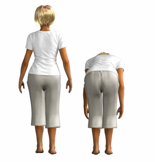 成長期以降の側弯症でお悩みの方　成長期終了後も継続的なケアはどうしたらよいのか？　