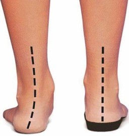 Foot Problems – Overpronation Support for Travelers & Residents